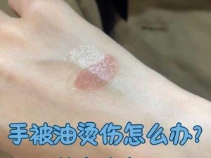 在厨房里两只被吸肿了，为什么会这样？如何缓解？